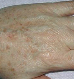pigmhand_before