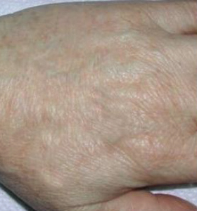 pigmhands_after-2-treat