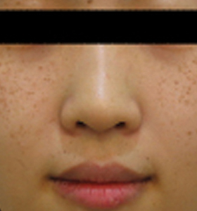 sun_pigmented_before